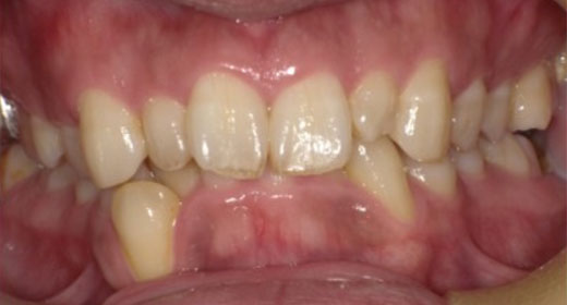 ttl-implant-img09.jpg